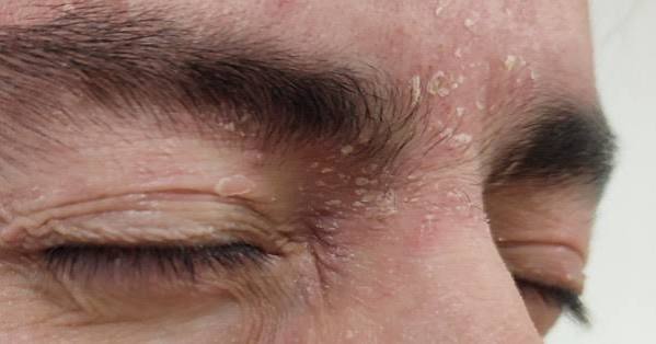 Dermatitis seborreica: tratamientos y cómo evitar su impacto