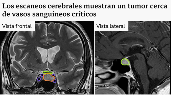 Primera cirugía cerebral del mundo con inteligencia artificial en tiempo real permite extirpar un tumor con éxito